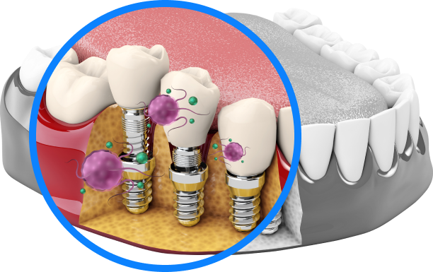 치아모형과 입속 세균